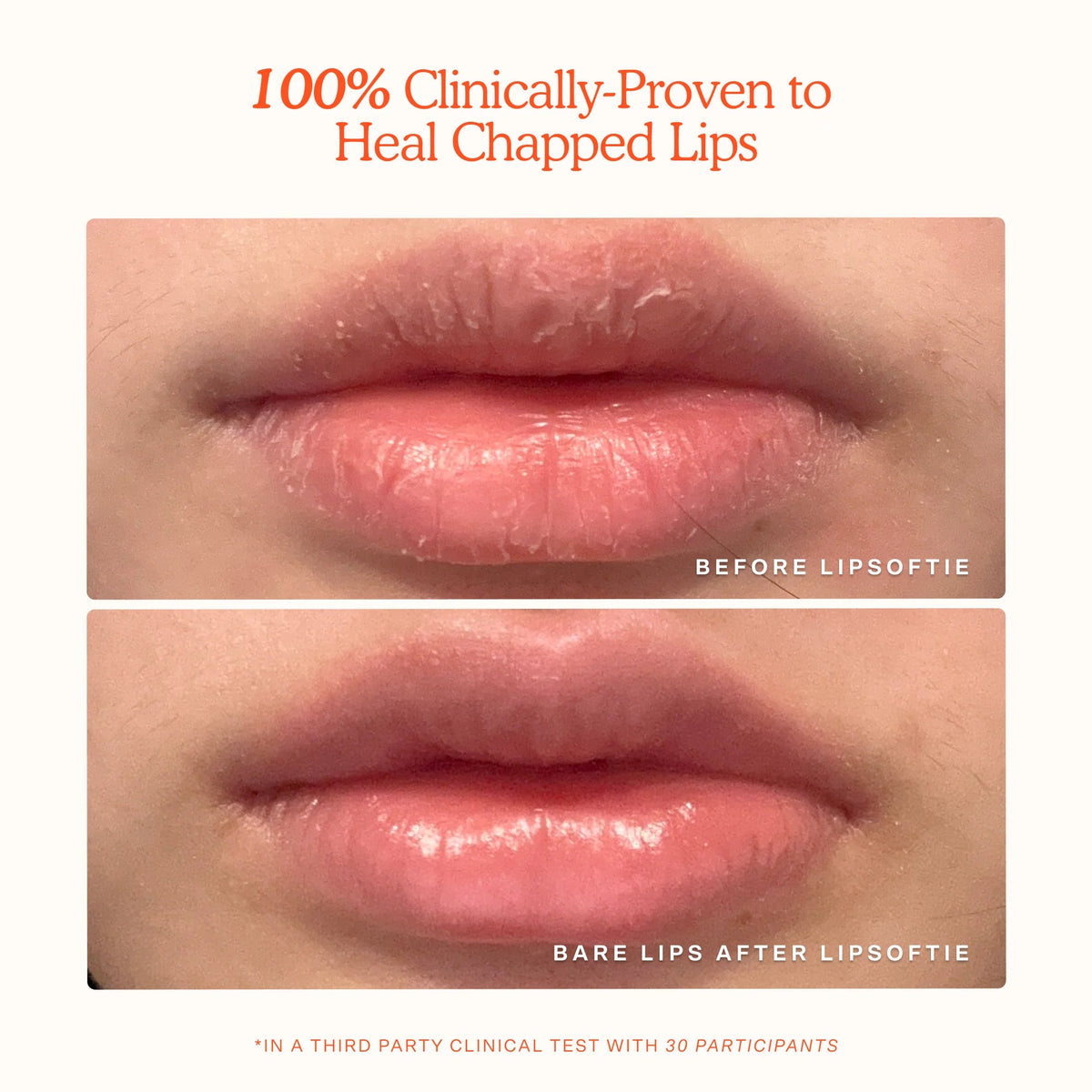 LipSoftie® Lip Treatment