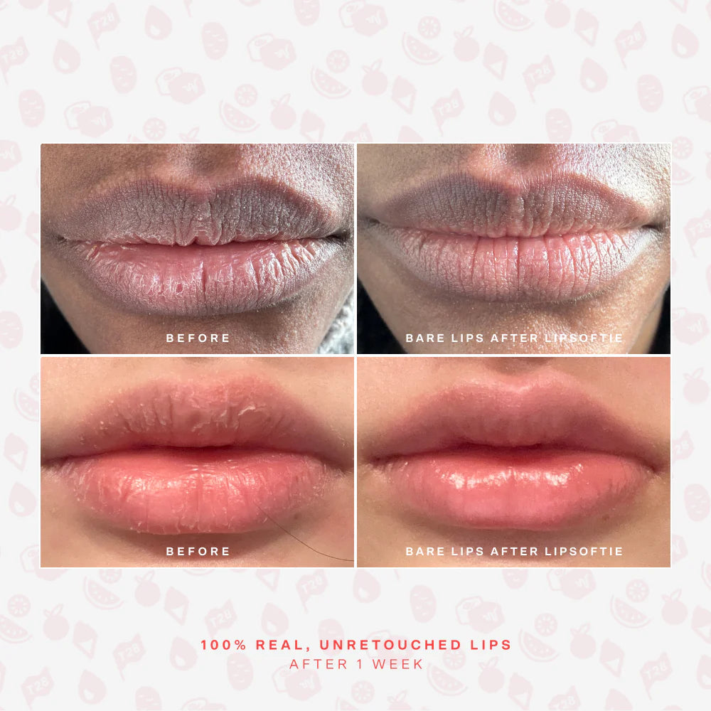 LipSoftie® Lip Treatment
