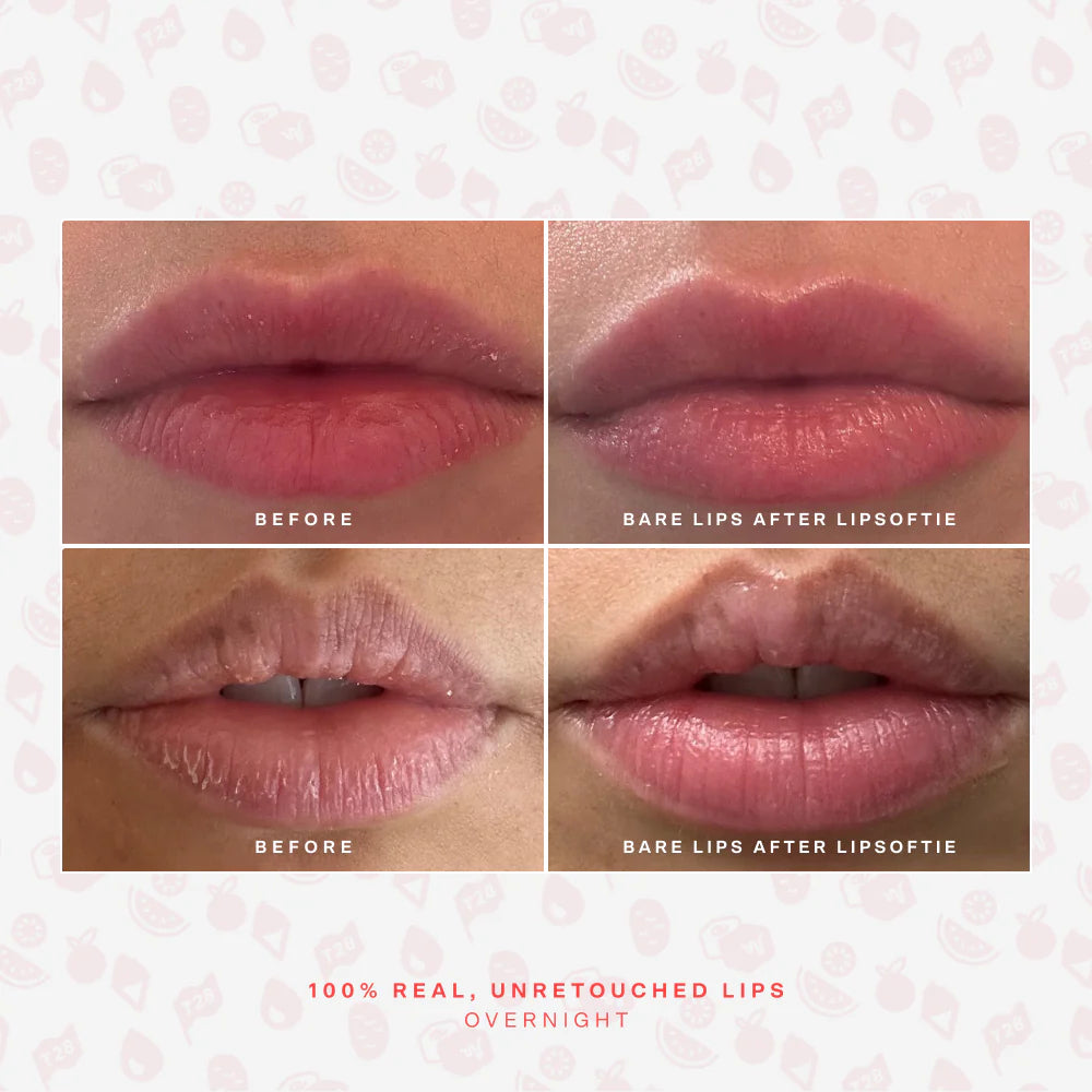 LipSoftie® Lip Treatment